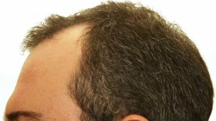 נשירת שיער, המכונה בעגה הרפואית אלופציה, היא תופעה שאופיינית לנשים וגברים בכל הגילאים, אולם היא נפוצה בקרב גברים בשיעור גבוה בכ-40% מאשר בנשים. נשירת השיער הגברית מיוחסת לשינוי מסוים שעובר...