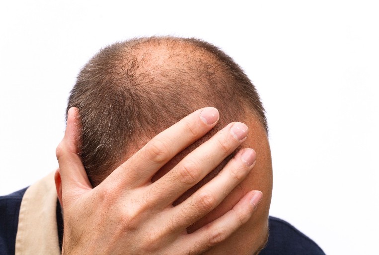 שבעה דברים שגברים צריכים ללמוד על התמודדות עם שיער דליל